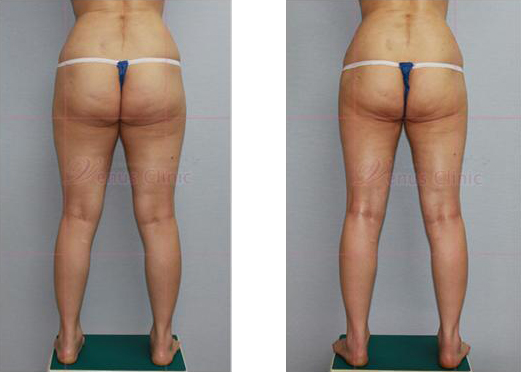 엉덩이 지방흡입 전후사진2