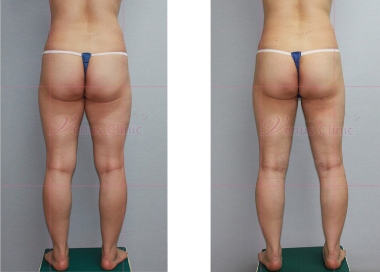 지방흡입전후 사진1