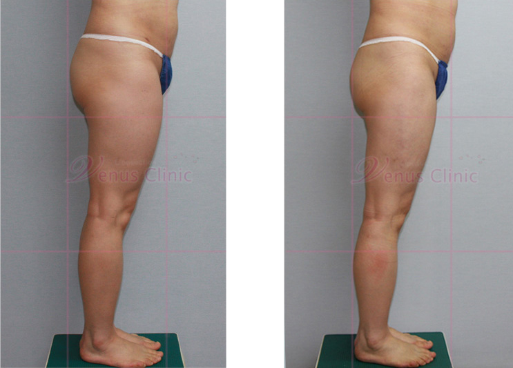 지방흡입전후 사진2