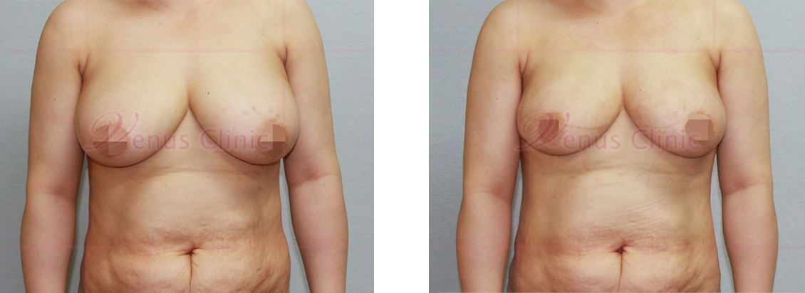 가슴축소 지방흡입 전후사진