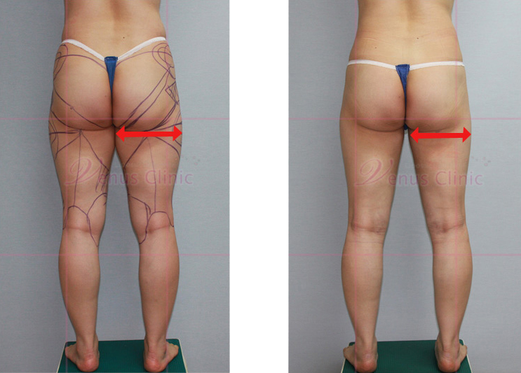 지방흡입전후 사이즈 측정