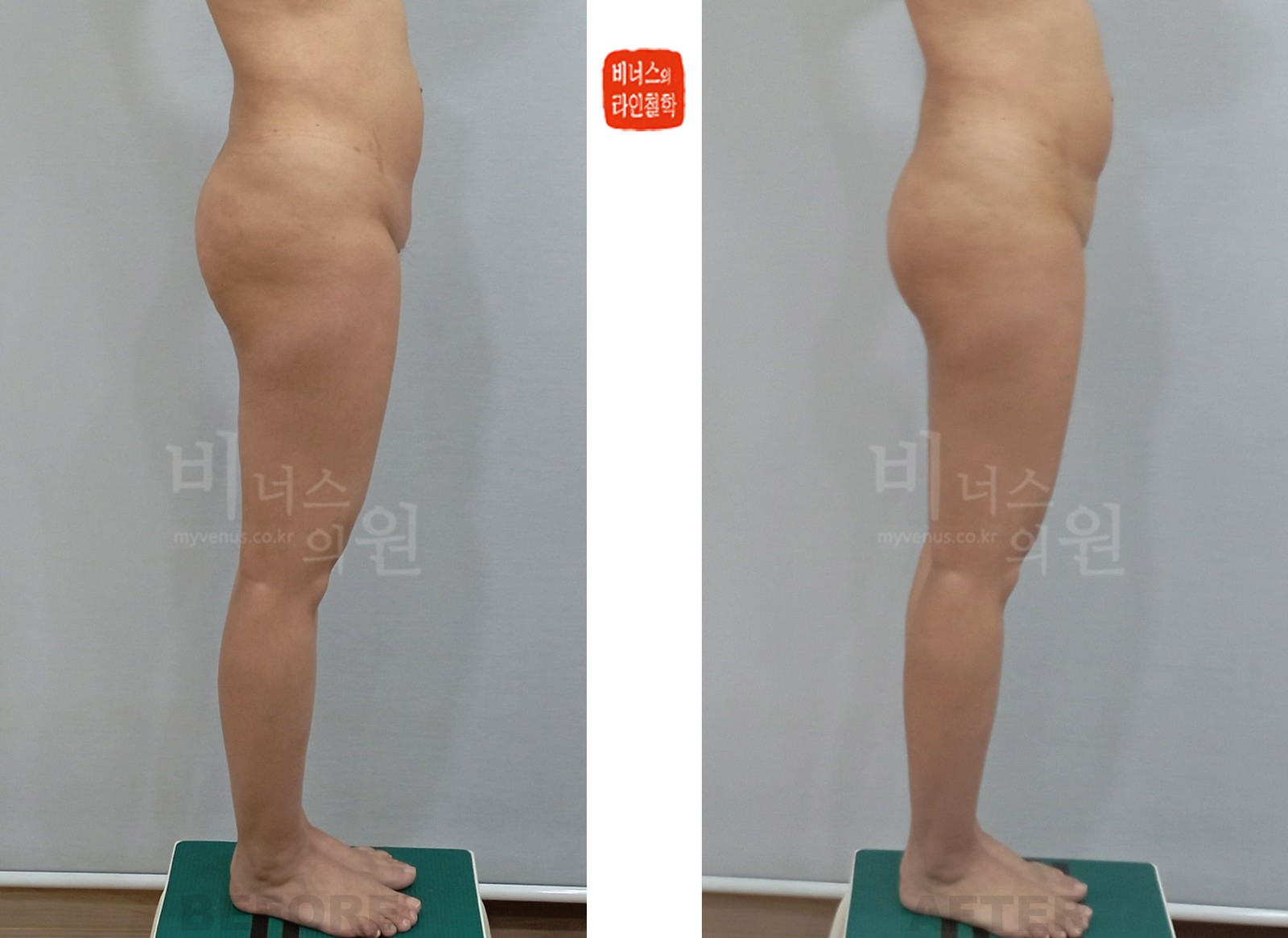 불균형비만 Y존 지방흡입 전후사진 첫 번째 케이스 측면 (수술 후 1주일)