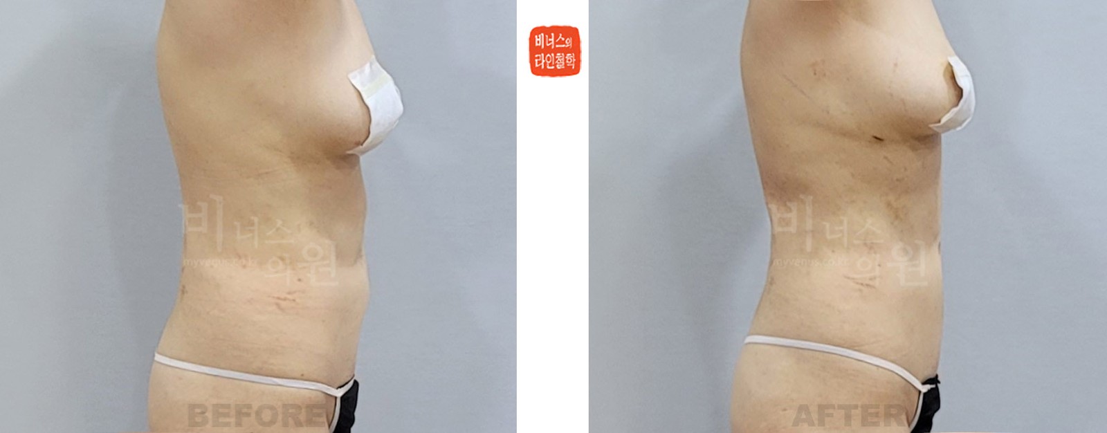 상복부 지방흡입 재수술 두 번째 케이스 전후사진 우측면 (수술 후 1주일)