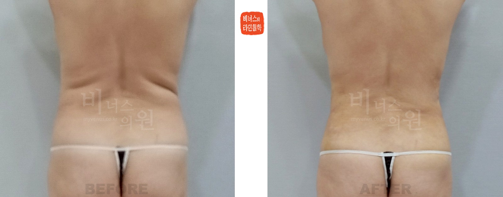 복부 지방흡입 전후사진 후면 (수술 후 1주일)