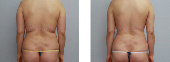 등과 허리의 지방흡입1
