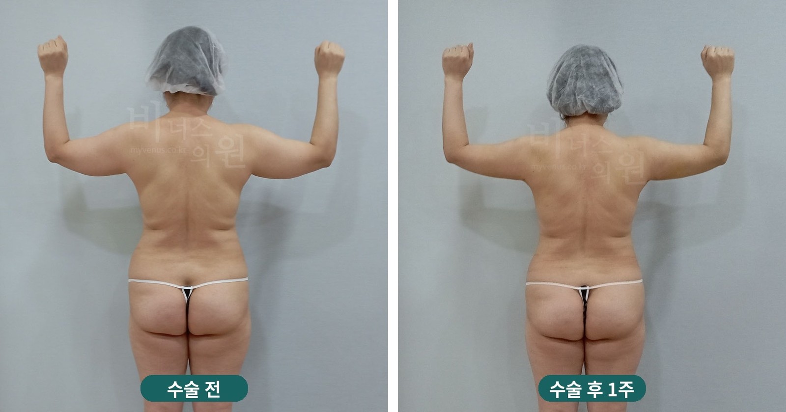 팔 지방흡입 전후사진 첫 번째 케이스 — 팔을 들어 올린 뒷모습 (수술 후 1주)