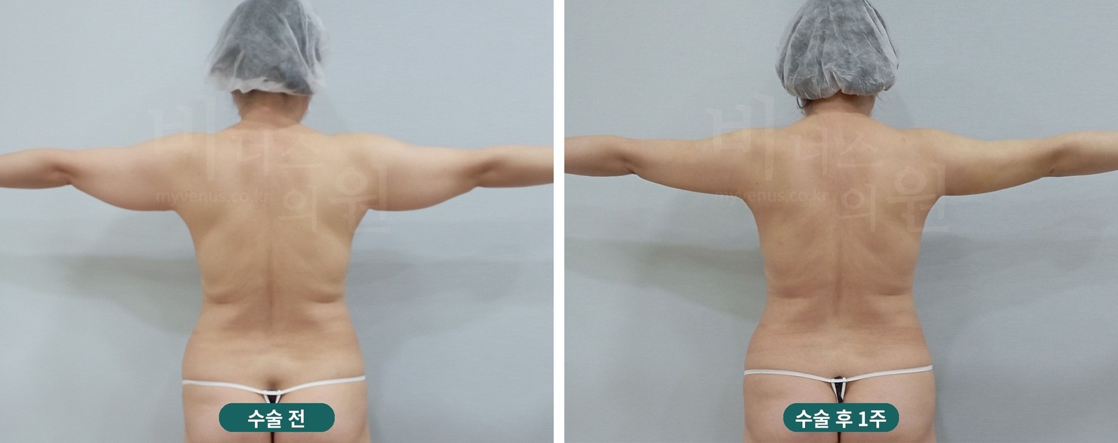 팔 지방흡입 전후사진 첫 번째 케이스 — 팔을 옆으로 벌린 뒷모습 (수술 후 1주)