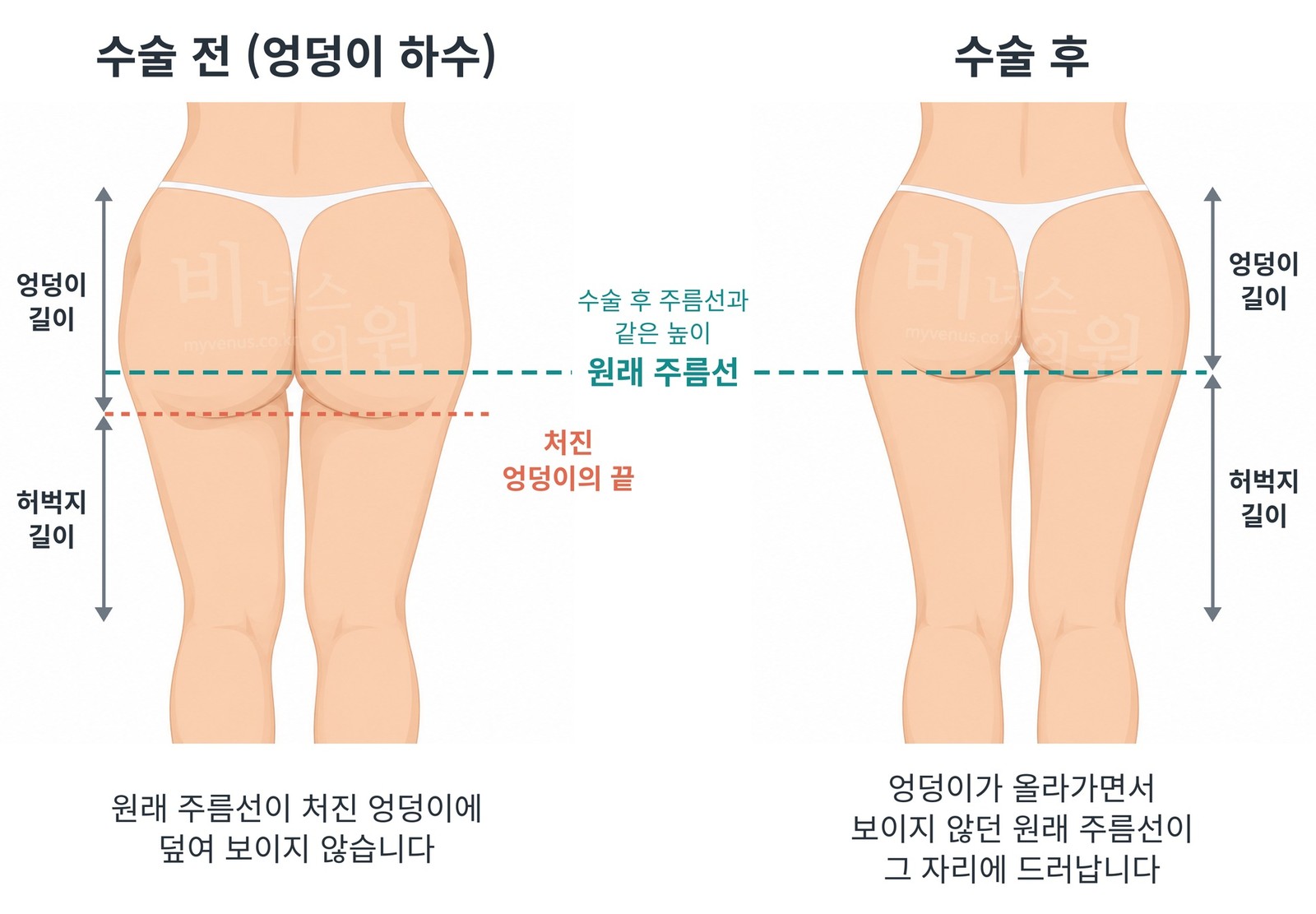 엉덩이 하수 지방흡입 수술 전과 수술 후의 후면 비교 — 처진 엉덩이에 숨어 있던 원래 주름선과 수술 후 주름선의 높이가 같은 경우