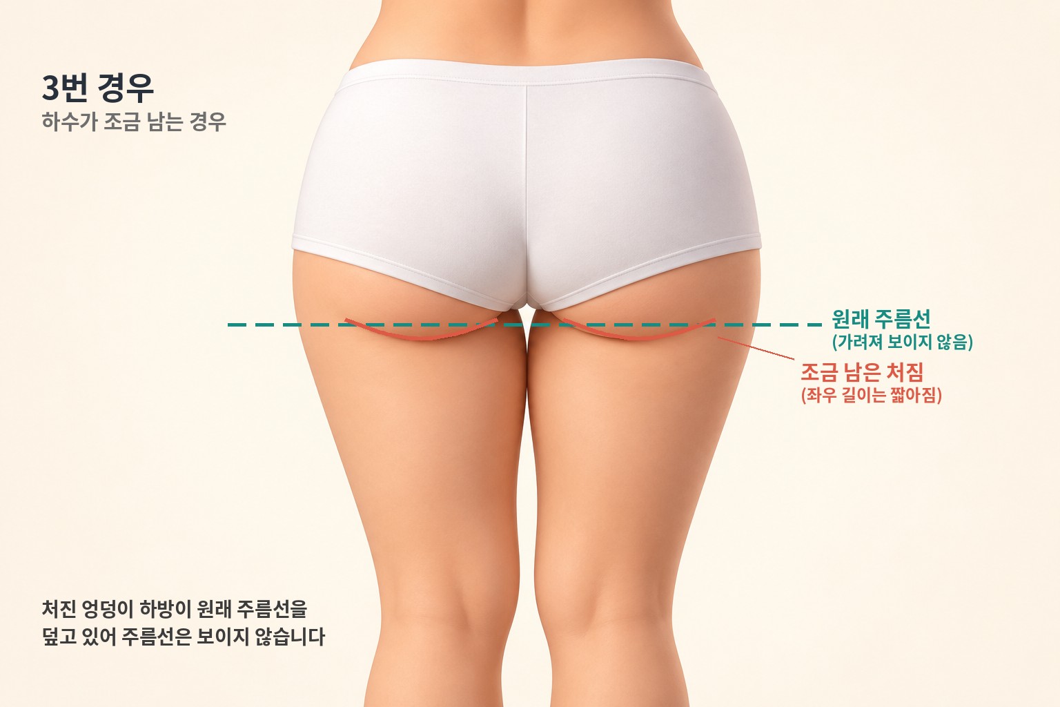 3번 경우 — 하수가 조금 남아 원래 주름선이 가려진 모습