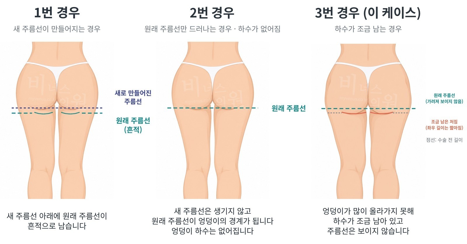 엉덩이 하수 지방흡입 후 주름선이 드러나는 세 가지 경우 비교 — 이 케이스는 3번 경우