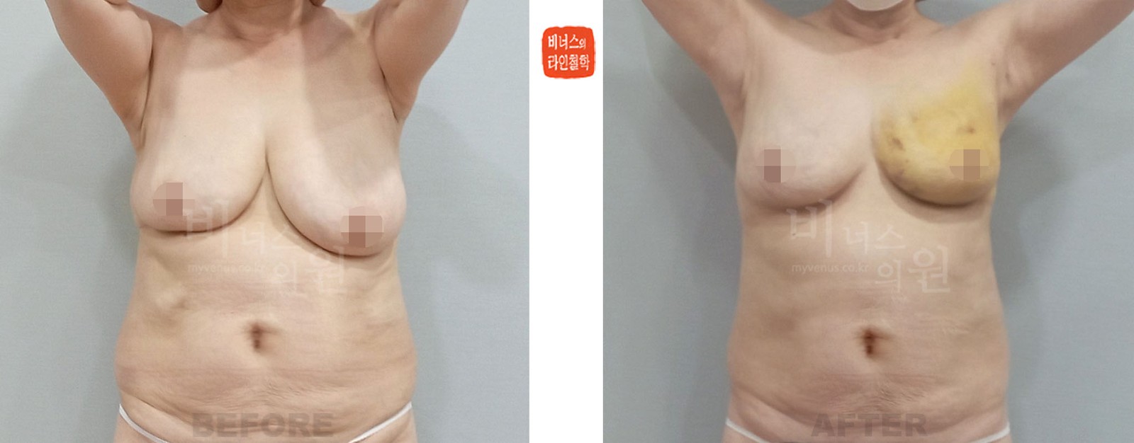 짝짝이 유방 좌측 지방흡입 전후사진 정면 (수술 후 1주일)