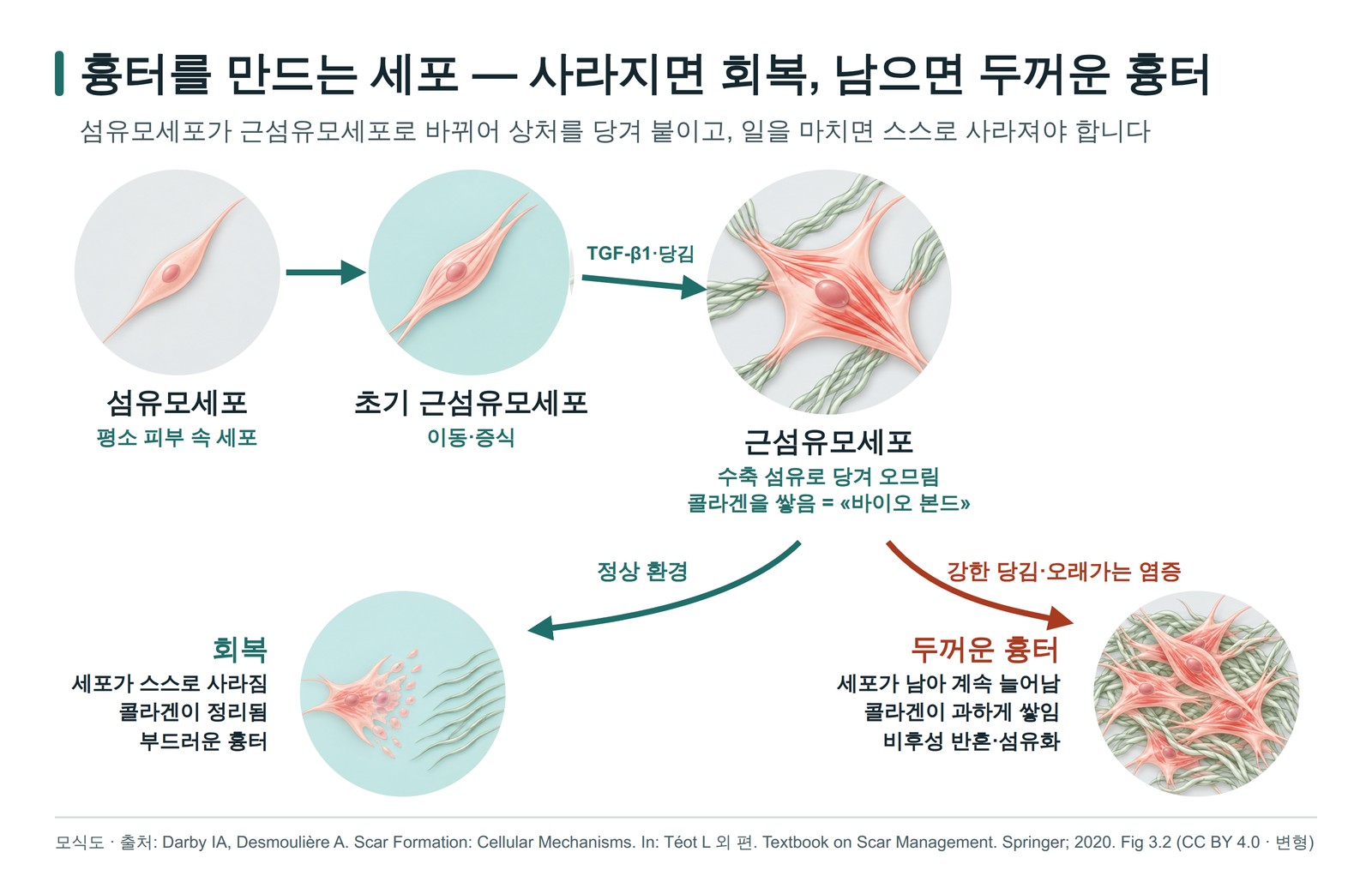 섬유모세포가 근섬유모세포로 바뀐 뒤 사라지면 회복되고 남으면 두꺼운 흉터가 되는 과정