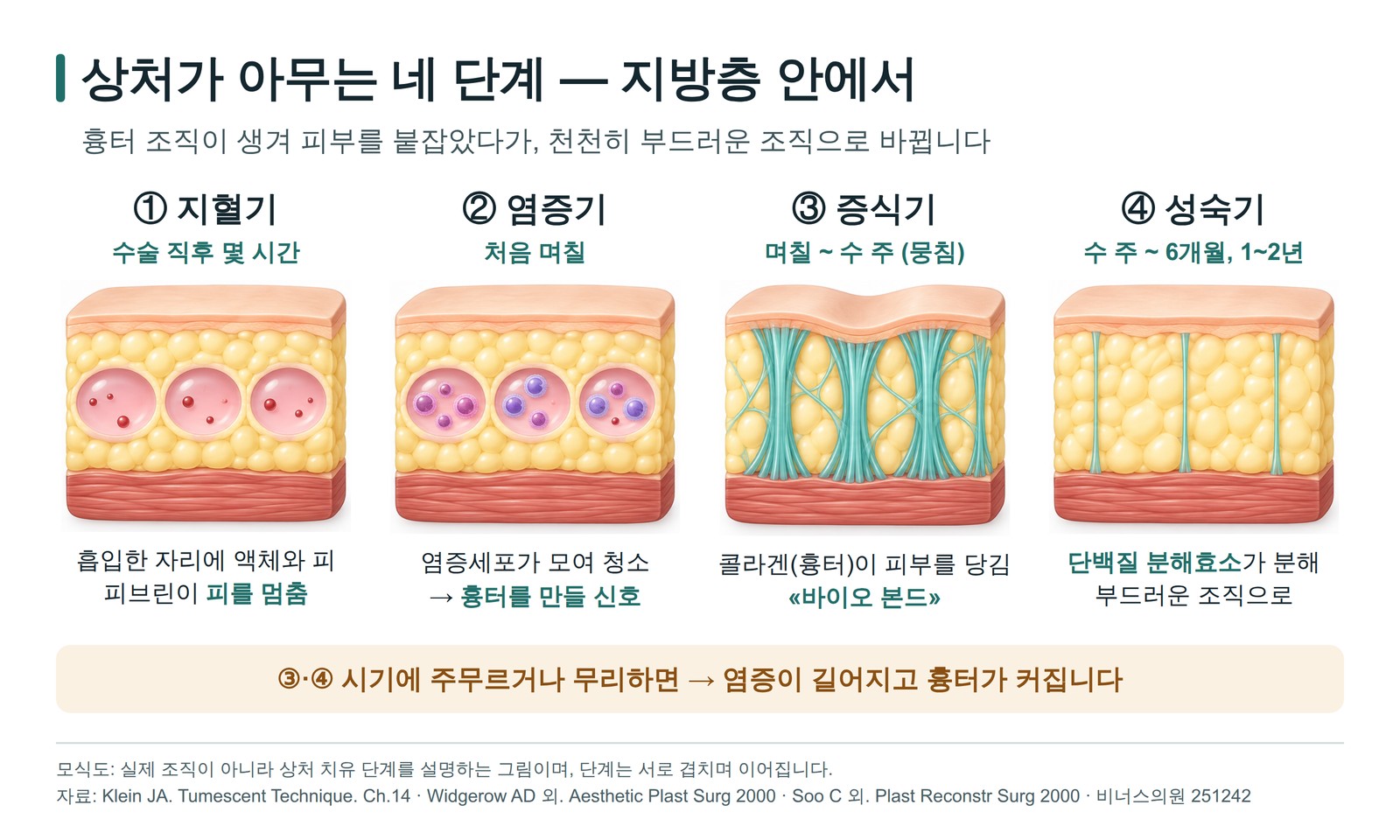 상처가 아무는 네 단계 지혈기 염증기 증식기 성숙기를 지방층 단면으로 그린 모식도
