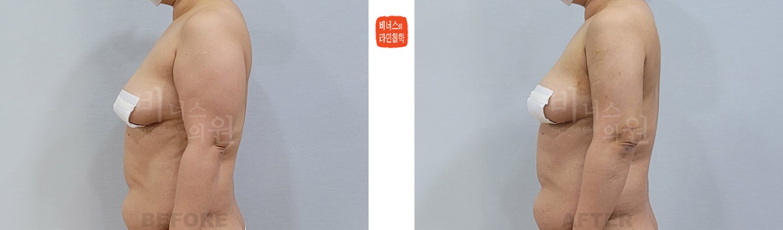 팔 전체와 겨드랑이 앞뒤 지방흡입 전후사진 측면 (수술 후 1주일)
