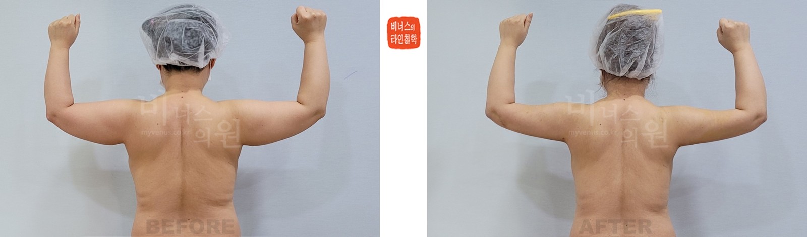팔 전체와 겨드랑이 앞뒤 지방흡입 전후사진 후면 (수술 후 1주일)