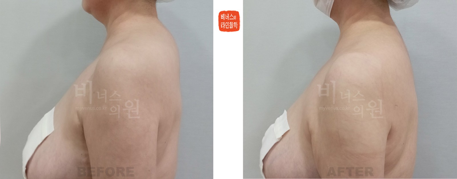 목 뒤 지방 지방흡입 전후사진 첫 번째 케이스 (수술 후 8일)