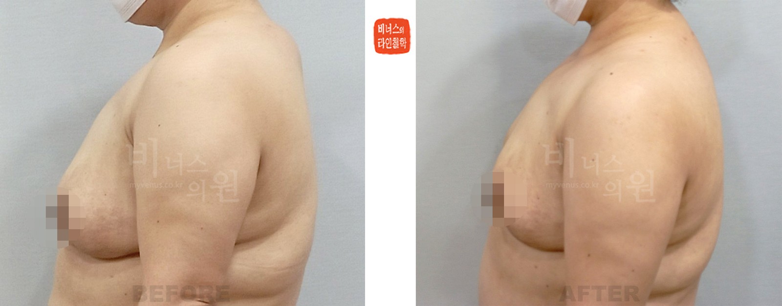 목 뒤 지방 지방흡입 전후사진 세 번째 케이스 (수술 후 11일)