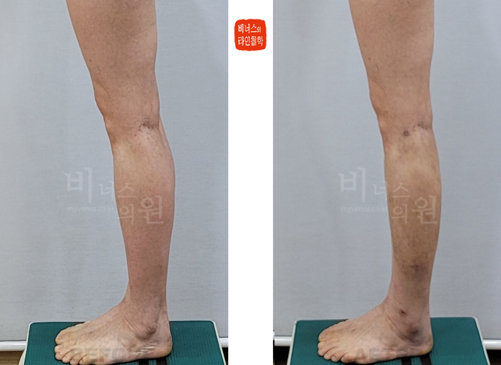종아리 지방흡입 전후사진 첫 번째 케이스 측면 (수술 후 10일)