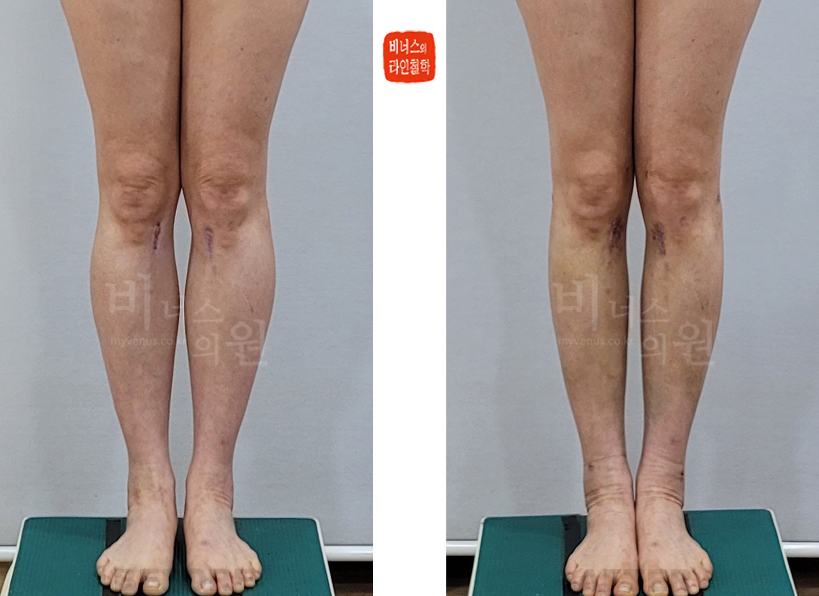 종아리 지방흡입 전후사진 첫 번째 케이스 정면, 다리를 붙인 모습 (수술 후 10일)