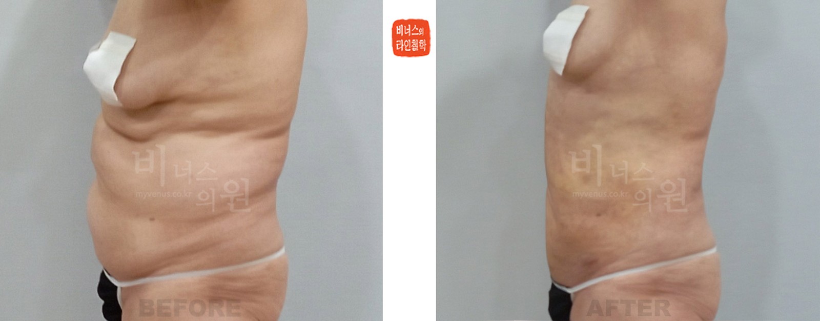 복부의 늘어진 피부 지방흡입 전후사진 좌측면 (수술 후 1주일)