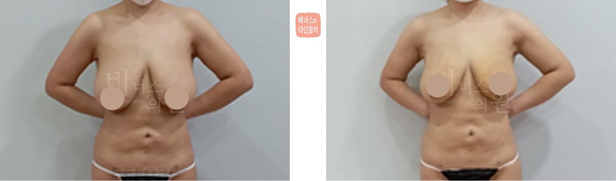 유방 지방흡입 축소 전후사진 정면 (수술 후 1개월)