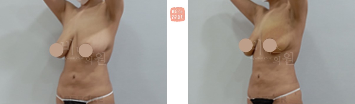 유방 지방흡입 축소 전후사진 좌측 사면 (수술 후 1개월)