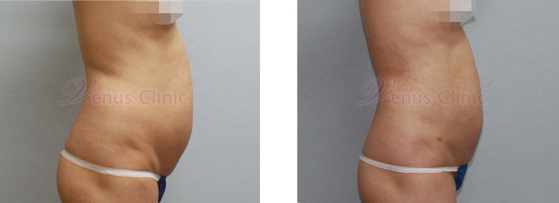 내장비만이 있으신 중년 여성분의 지방흡입 전후사진 3