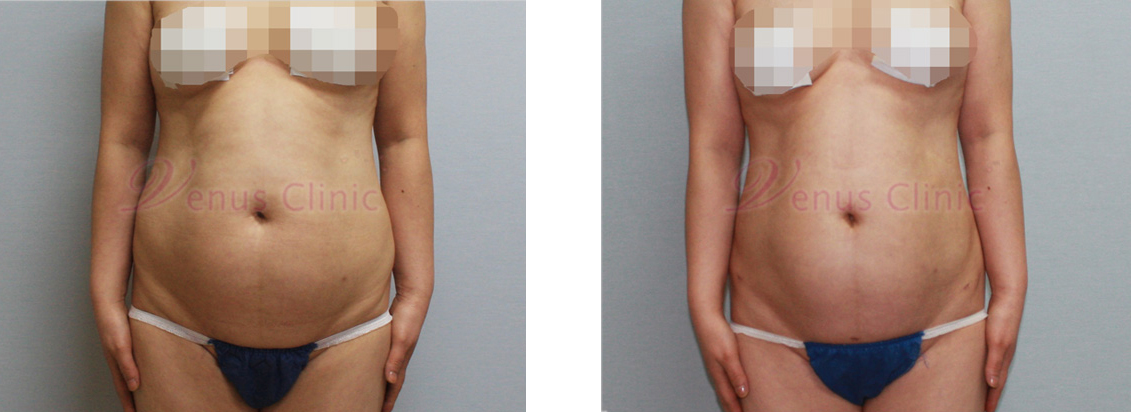 내장비만이 있으신 중년 여성분의 지방흡입 전후사진 1