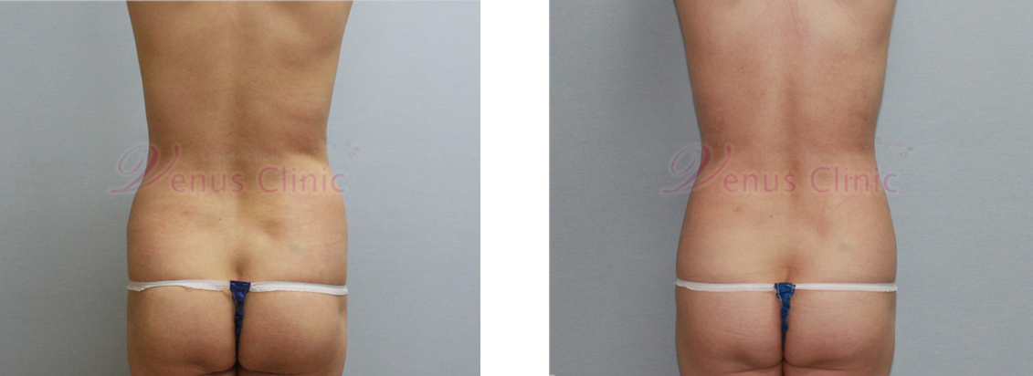 내장비만이 있으신 중년 여성분의 지방흡입 전후사진 5