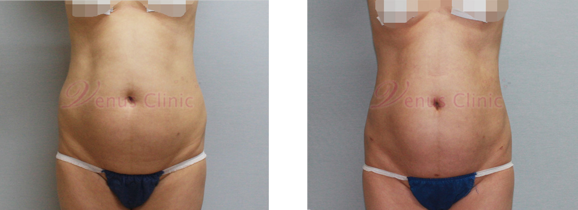 내장비만이 있으신 중년 여성분의 지방흡입 전후사진 2
