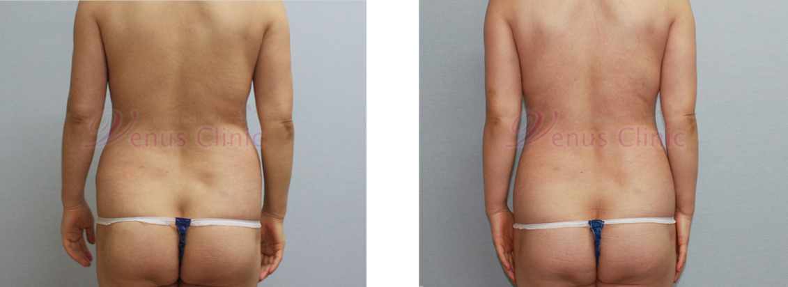 내장비만이 있으신 중년 여성분의 지방흡입 전후사진 4