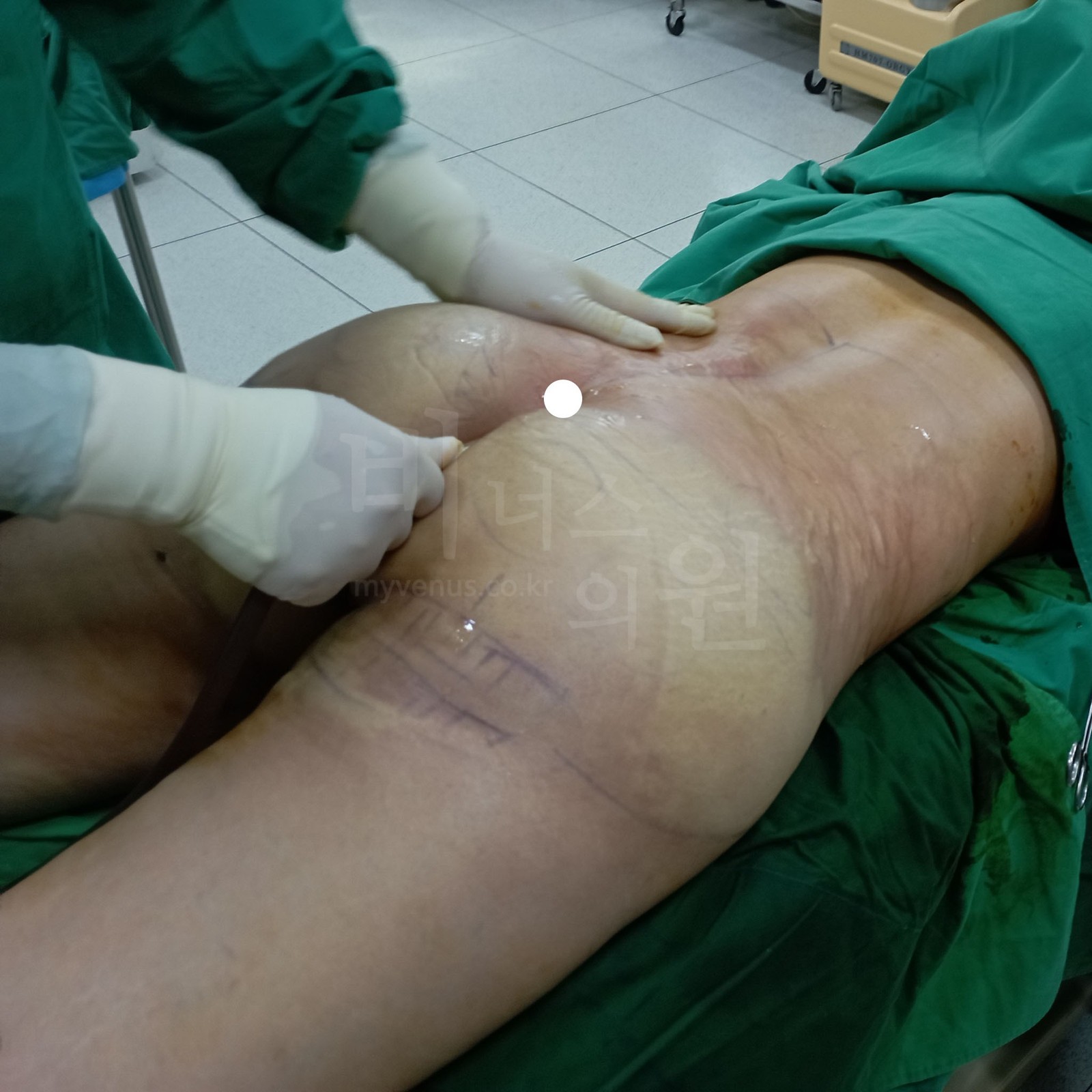 비너스의원 수술 장면 — 엉덩이 아래쪽 굴곡을 따라 캐눌라를 손으로 넣는 모습