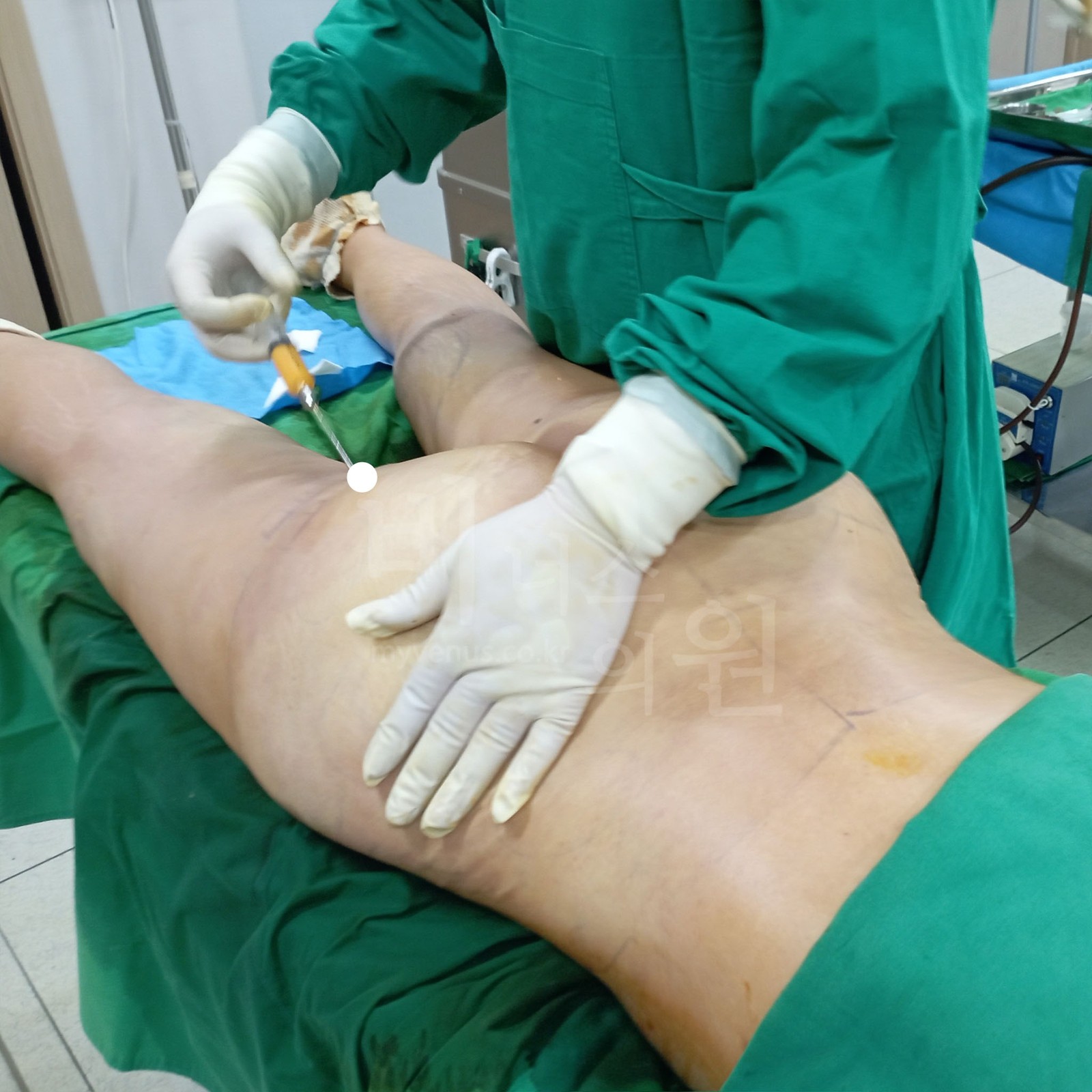비너스의원 수술 장면 — 한 손으로 조직을 잡고 다른 손으로 캐눌라를 넣어 엉덩이 하방과 허벅지 상부를 흡입하는 모습