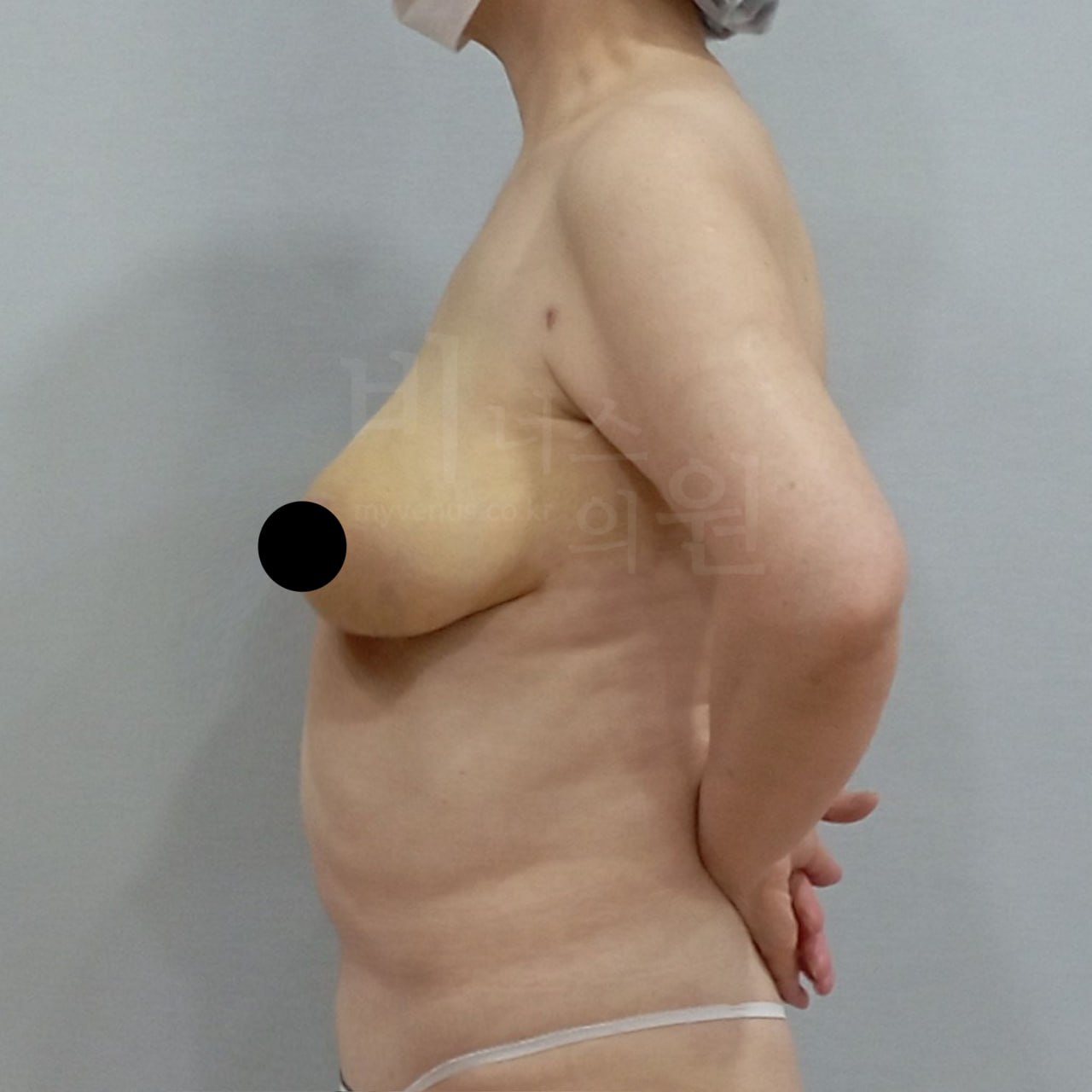 가슴축소 우측면 수술후