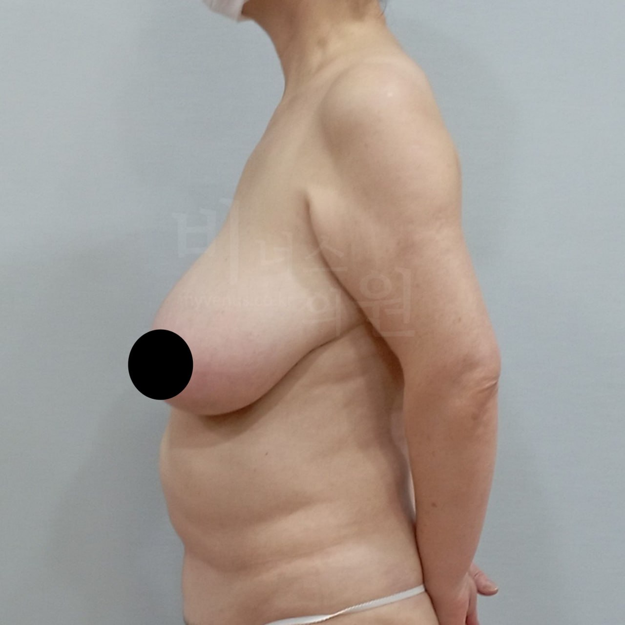 가슴축소 우측면 수술전