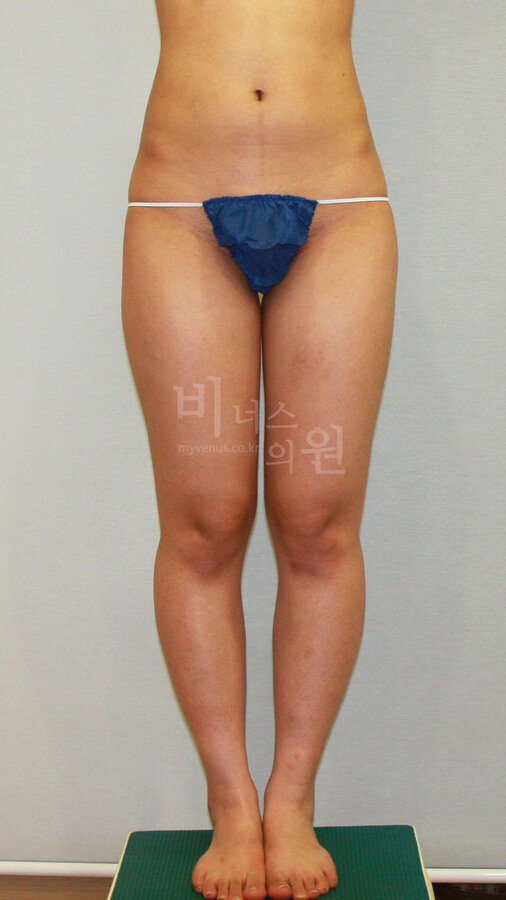 허벅지 지방흡입 수술 전 정면 비너스의원