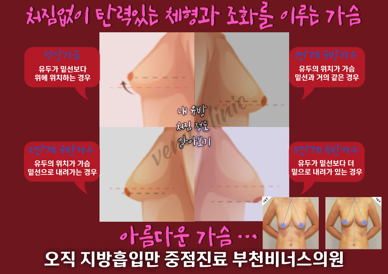 유방축소지방흡입-002 (3).png