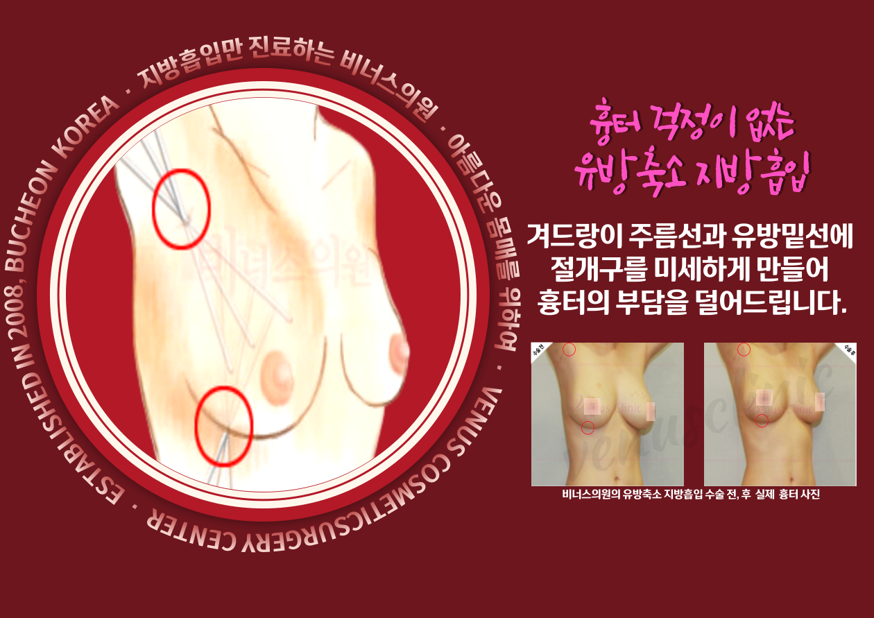 유방축소지방흡입-006 (2).png