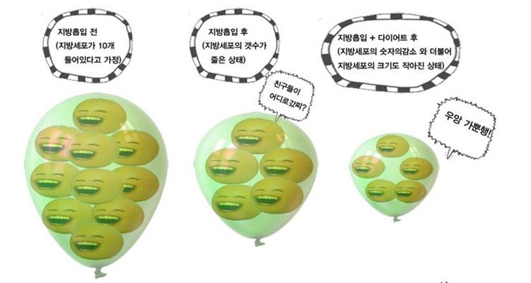 부천지방흡입,인천지방흡입,지방흡입과 다이어트차이