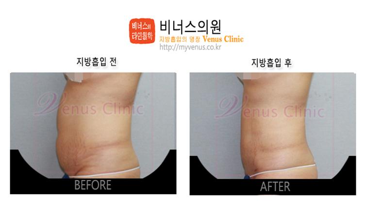 부천지방흡입,인천지방흡입,지방흡입과 다이어트차이