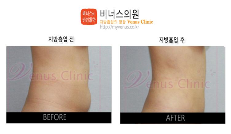 부천지방흡입,인천지방흡입,지방흡입과 다이어트차이