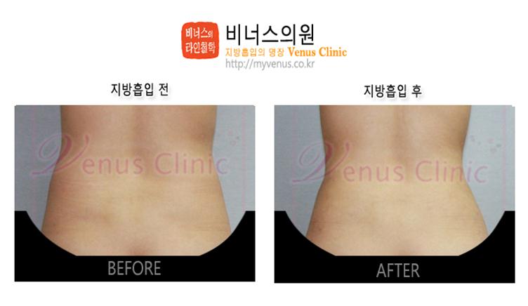 부천지방흡입,인천지방흡입,지방흡입과 다이어트차이
