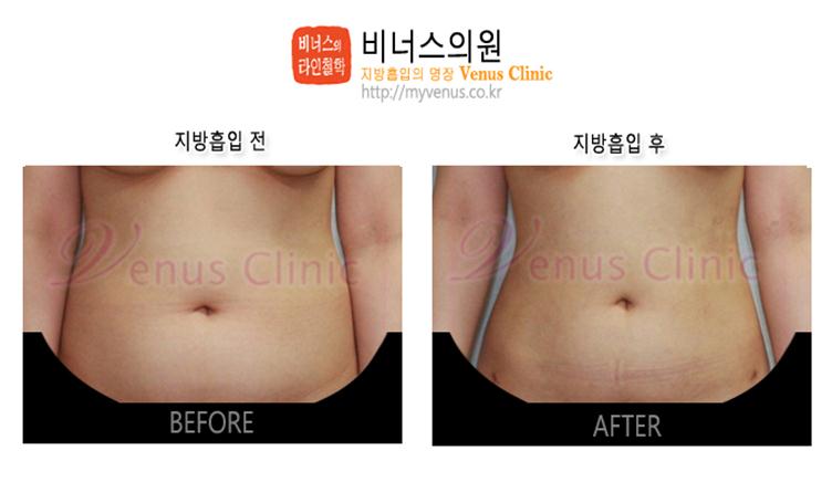 부천지방흡입,인천지방흡입,지방흡입과 다이어트차이