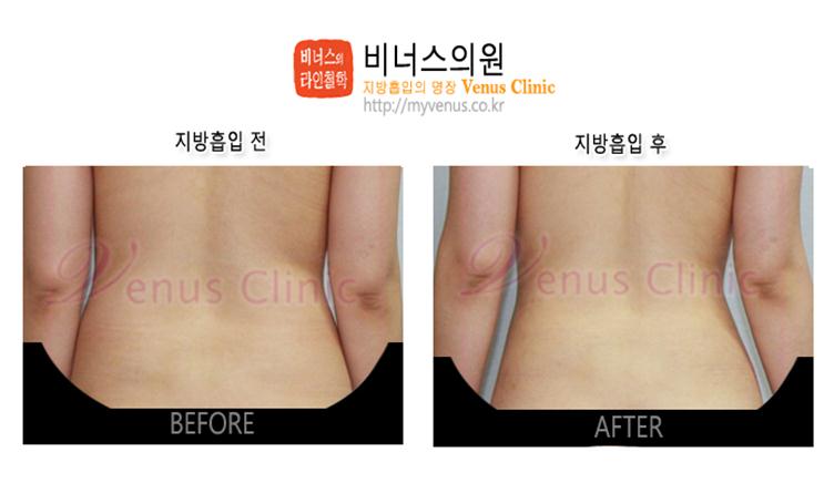 부천지방흡입,인천지방흡입,지방흡입과 다이어트차이