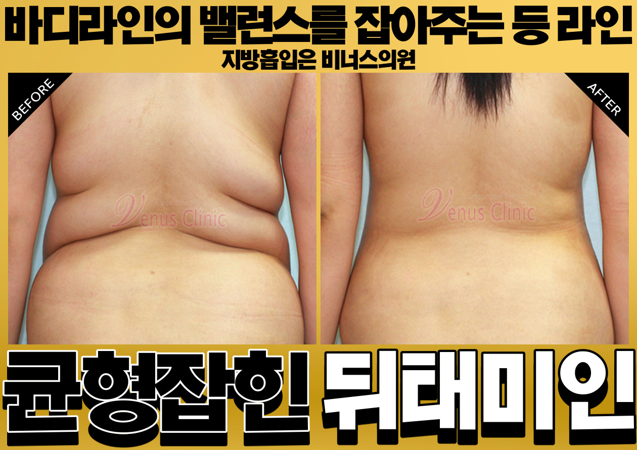 등지방흡입-005 (1).jpg