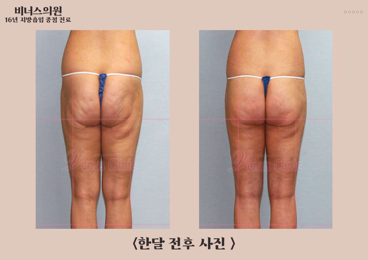 허벅지재수술-005 (1).jpg