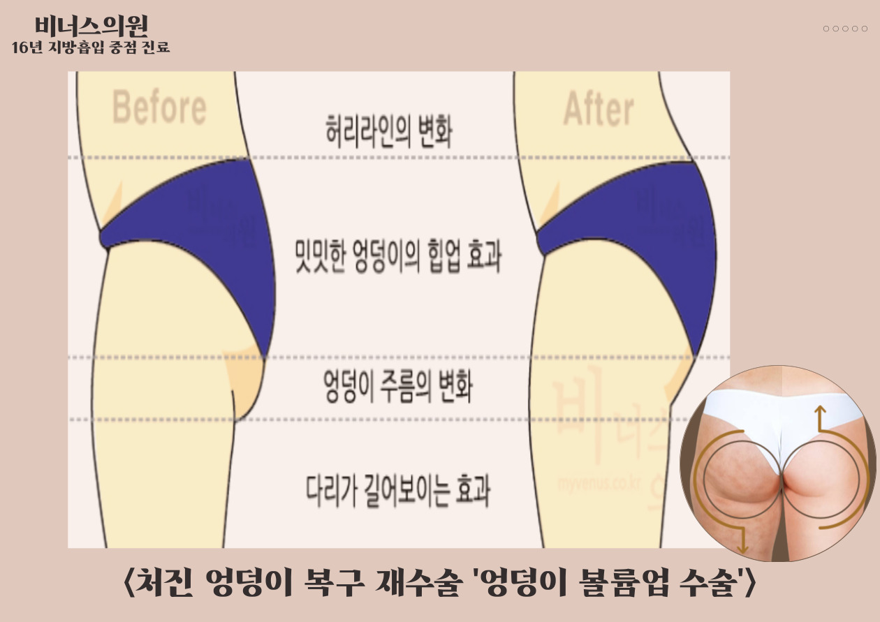 허벅지재수술-004.jpg