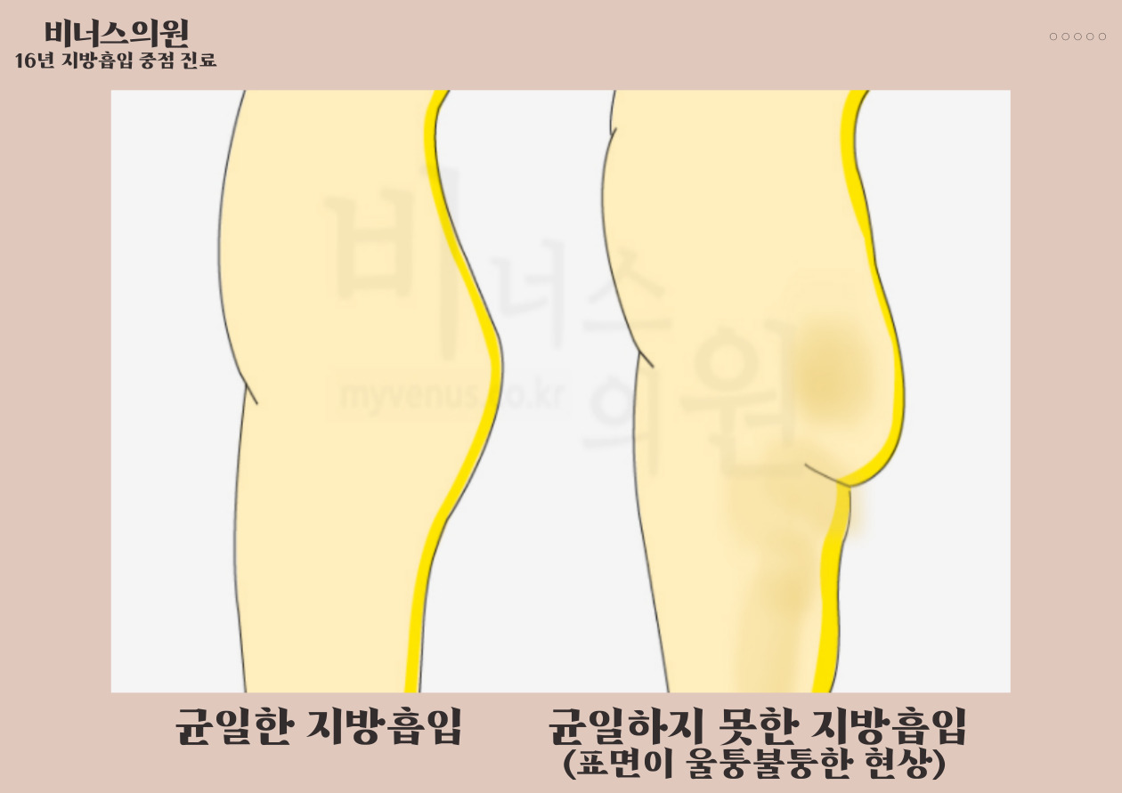허벅지재수술-006.jpg