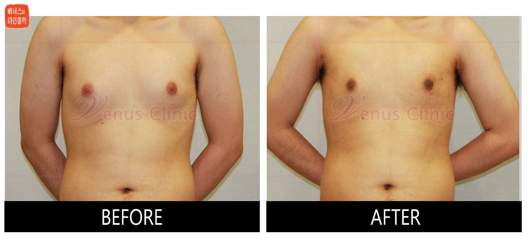 true_-gynecomastia1.jpg