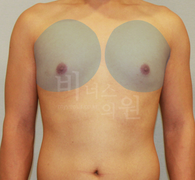 special_gynecomastia 1.jpg